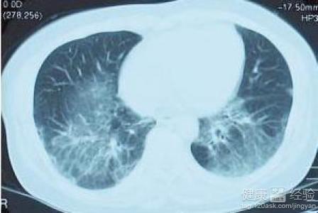 间质性肺炎最新药物研究突破与进展概述